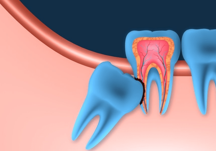 wisdom teeth Solution - Dentist Maroubra