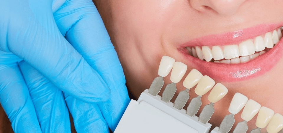 dental veneers clinic